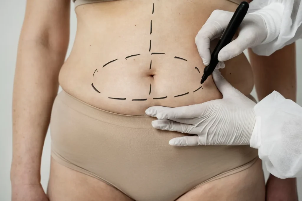 Maestría en Abdominoplastia y Cirugía Postbariátrica 1