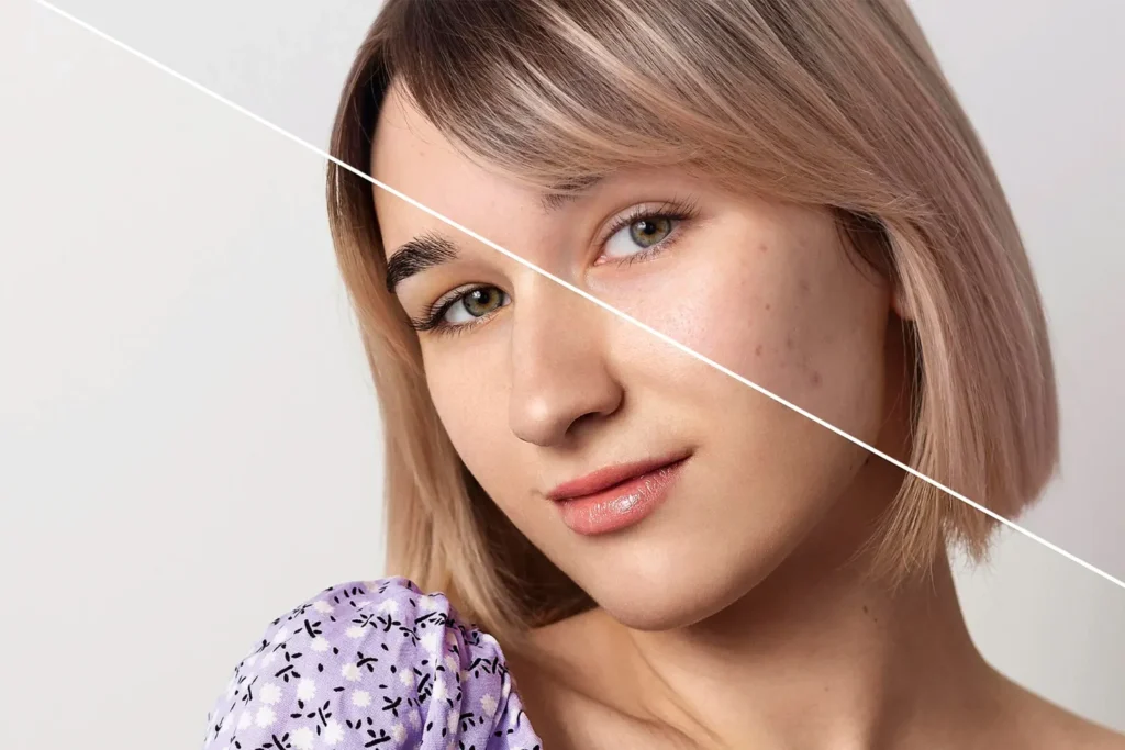 Maestría en Hiperpigmentaciones Melasma PIH y Tratamientos Combinados 1