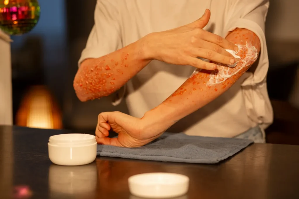 Maestría en Dermatitis Atópica y de Contacto y su Impacto Estético 3