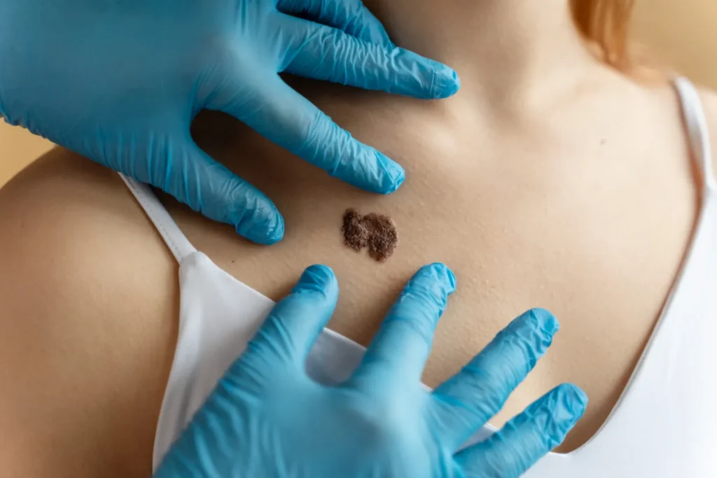 Master en Complications Cutanées en Esthétique, Nécrose, Granulomes et Infections 2